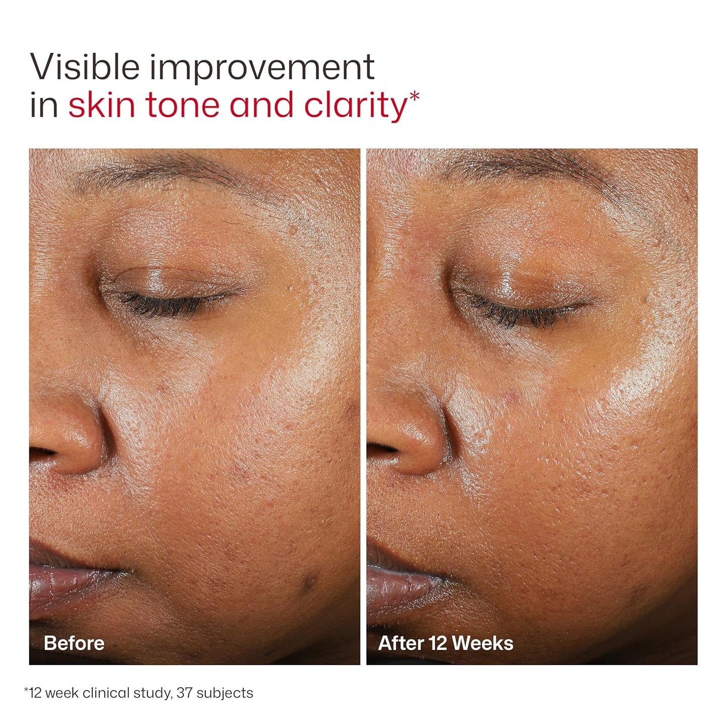 UV Clear Face Sunscreen SPF, Oil-Free Sunscreen with Zinc Oxide, Dermatologist Recommended