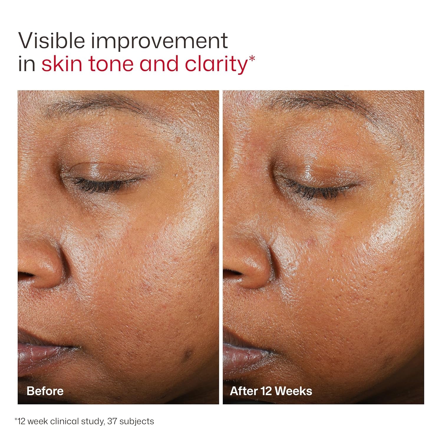 UV Clear Face Sunscreen SPF, Oil-Free Sunscreen with Zinc Oxide, Dermatologist Recommended